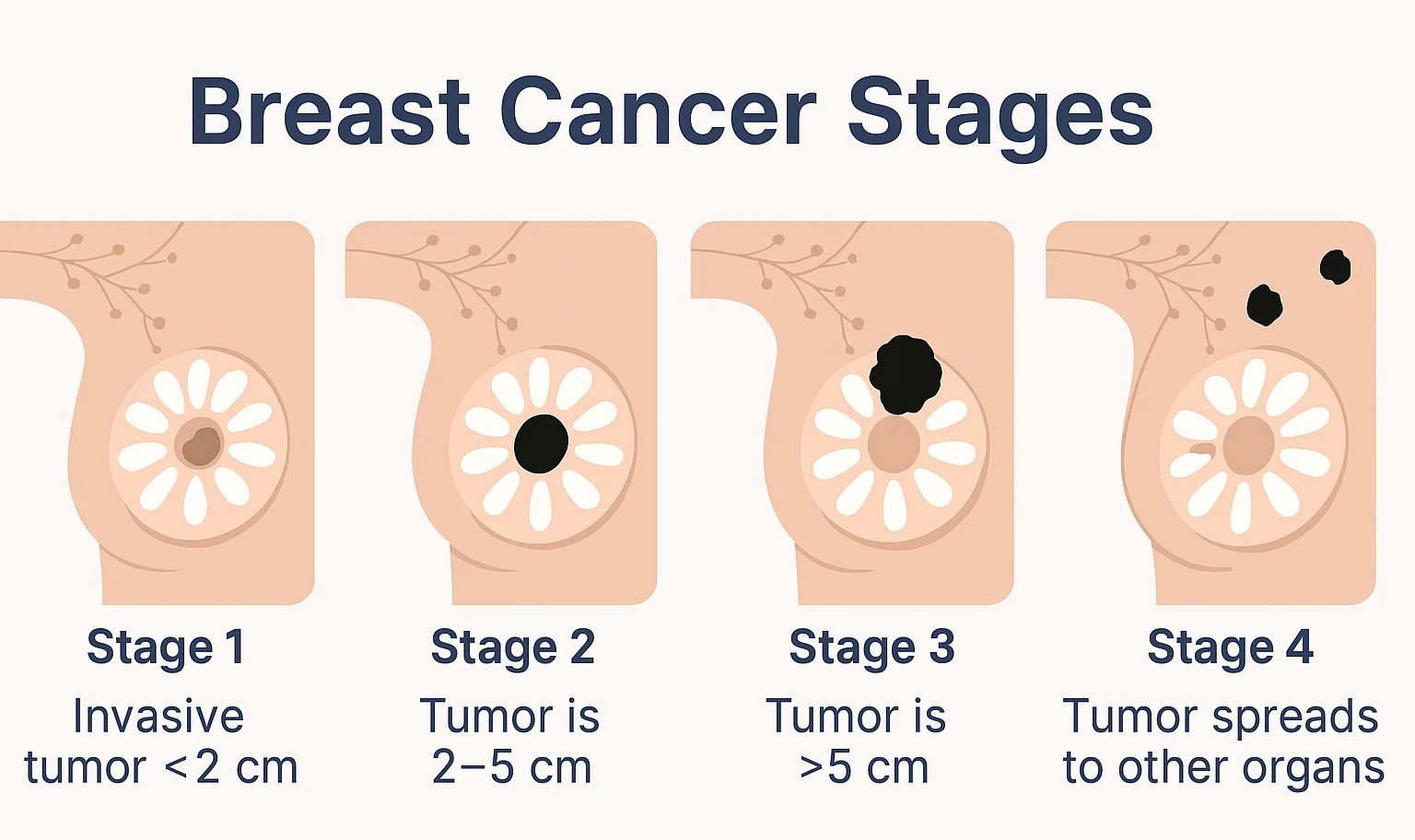 Breast Cancer