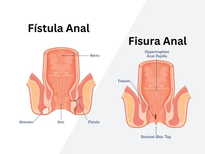 Fistula Treatment Near Me In Chandkheda, Ahmedabad